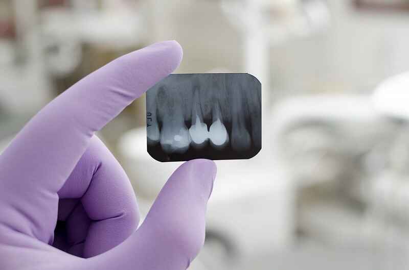 How harmful are x-rays in dentistry?