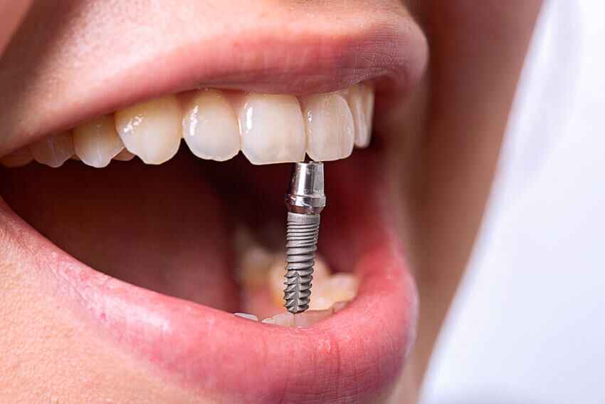 Types of dental implants