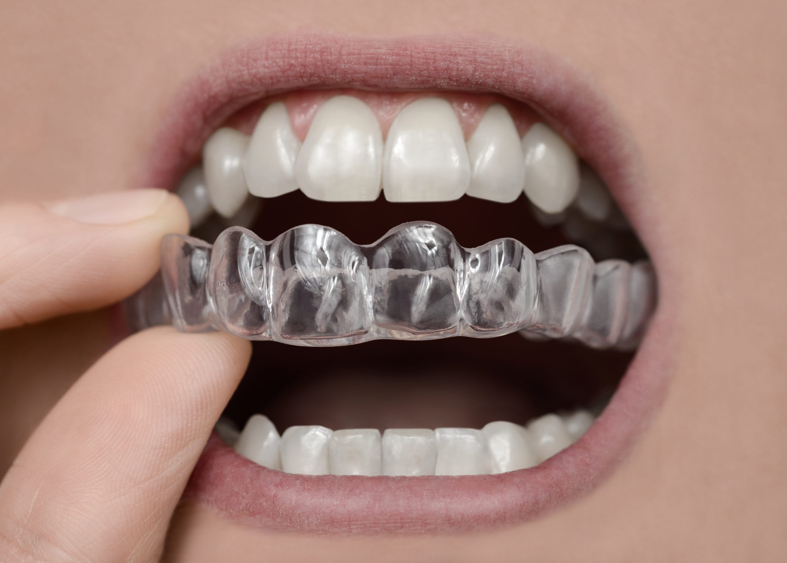 Dental plates