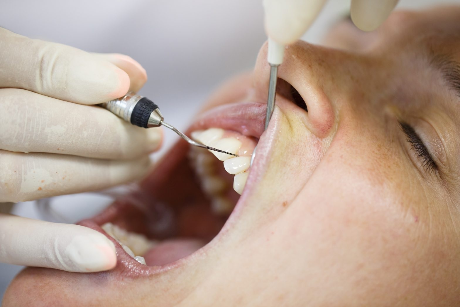 Periodontitis treatment