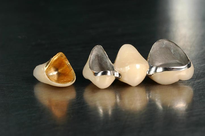 Metal-ceramic crowns